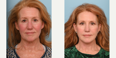 55-64 year old woman treated with Facial Fat Transfer - The doctor preformed and Extended Deep Plane Face & Neck Lift with Fat Transfer, Temporal Browlift & Upper Blepharoplasty 3 months ago to give her a naturally refreshed look.