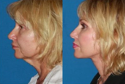 55-64 year old woman treated with Facelift - This patient presented with complaints of facial aging. Her primary concerns were sagging cheeks, significant jowls, and neck skin laxity. She also felt that her eyes appear tired. Face and neck lift and upper blepharoplasty was performed. Significant facial rejuvenation was achieved with removal of sagging neck skin, restoring smooth jawline and elevating midface. The eyes appear larger and youthful with removal of excess eyelid skin.