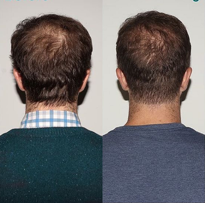 Patient treated with Nutrafol - Nutrafol is scientifically proven to increase hair growth and hair quality after 3 months of consistent daily consumption! 100% drug free with all natural, medical grade ingredients!
