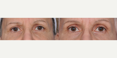 Woman treated with ThermiSmooth - Woman treated with ThermiSmooth