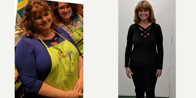 45-54 year old woman treated with Orbera Intragastric Balloon - Orbera Intragastric Balloon before and after