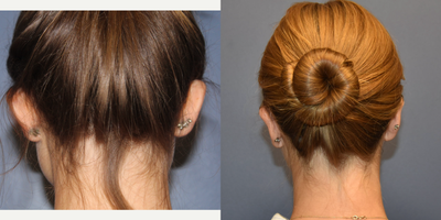 18-24 year old woman treated with Ear Surgery - 20 year old undergoing ear surgery (otoplasty) for prominent ears.