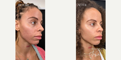 Woman treated with Neo Laser, IPL - Woman treated with Neo Laser, IPL