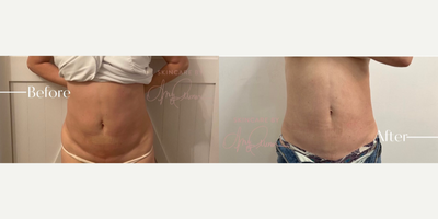 Woman treated with Eon - Woman treated with Eon