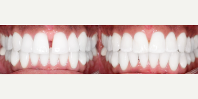 25-34 year old man treated with InBrace - This InBrace patient was treated over 12 months to close the gap between his two front teeth and fix minor crowding.