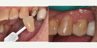 55-64 year old man treated with Dental Crown - Custom shading completed by one of on-staff ceramists