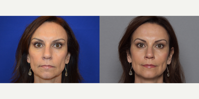 35-44 year old woman treated with Sculptra - 35-44 year old woman treated with Sculptra in her cheek area