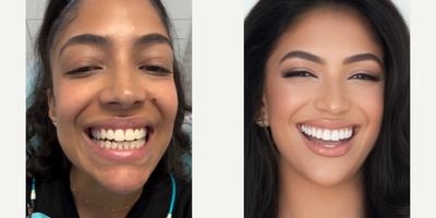 Woman treated with Smile Makeover, Teeth Whitening - I want to thank EMPOWER YOUR SMILE for helping me achieve a brighter smile.I have a really exciting announcement coming soon and Dr.Patricia Moezinia has been helping me for over a year to achieve my perfect smile.