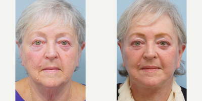 65-74 year old woman treated with Facelift - She undergoes upper and lower blepharoplasty-skin muscle flap, face/necklift, platysmaplasty, and full face fractional CO2 resurfacing.  She is the definition of looking younger than her stated age.