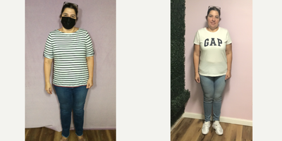 35-44 year old woman treated with Endoscopic Sleeve Gastroplasty - She lost 53 Lbs in 13 months after her Endoscopic Sleeve Gastroplasty procedure.