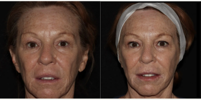 Woman treated with Emface - Emface