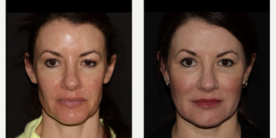 Woman treated with Emface - Emface