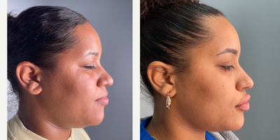 18-24 year old woman treated with Kybella, Lip Fillers, Chin Filler, Juvederm - patient treated with kybella, cheek, chin, and lip fillers over a series of 6 months