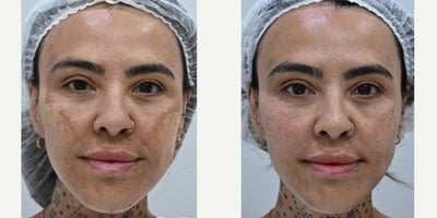 Melasma, dark spots, and skin texture improvement after combination laser treatment - Combination laser treatment focused on improving melasma, dark spots, uneven skin tone, and overall skin texture. These photos were taken 9 days after treatment during the early recovery stage. Individual results and recovery may vary depending on skin condition and treatment response.