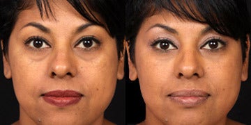 How Much Does Restylane Cost? Restylane Injections Prices