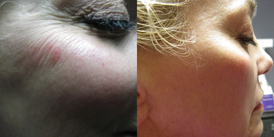 55-64 year old woman treated with eMatrix - ematix done on face for broken capillaries on face