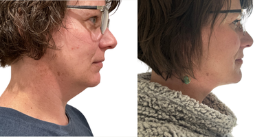 Double Chin Funsculpting HD Lipo 40 yr old female - 40 year old female double chin 1 session Funsculpting HD lipo. Awake procedure, no downtime. Wore compression for 2 weeks. No additional fillers or weight loss to achieve results, just the Funsculpting HD Lipo.