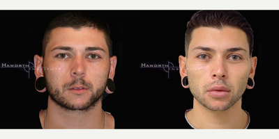 18-24 year old man treated with Lip Surgery - This patient had a combination facial rejuvenation procedure done including a fat transfer to his jawline and cheeks, lip augmentation and injectables in order to reshape, masculinize and sculpt his face.