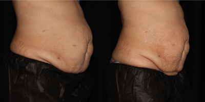 35-44 year old woman treated with EndyMed 3Deep - Received Endymed treatment with Radio Frequency for toning and tightening of the skin on her abdominals - patient will receive 8 treatments. These amazing results after only 1 treatment.