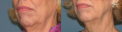 Thermage full face and  neck - 	1 mth post thermage full face and neck skin tightening