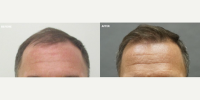 Man treated with Hair Loss Treatment - Man treated withHair Loss Treatment usingHair Transplant
