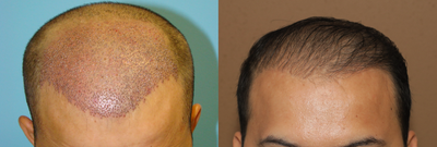 45-54 year old man treated with Hair Transplant - 2500 Units