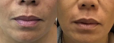 55-64 year old woman treated with DefenAge - Treated with DefenAge for 2 weeks for hyper-pigmentation