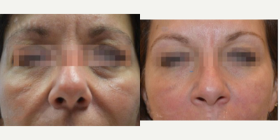 45-54 year old woman treated with multiple Fractora RF treatments - 45-54 year old woman treated with multiple Fractora RF treatments