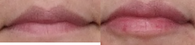 42 year old woman treated for Lip Augmentation with Restylane Silk - This patient chose to use Restylane Silk to provide a beautiful and subtle lip augmentation.