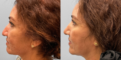 35-44 year old woman treated with Rhinoplasty - This woman in her mid-forties met with Dr. Tucker to discuss her interest in nose contouring. She wanted to reshape the hump on her dorsal and she chose to proceed with a closed rhinoplasty. She looks great and is featured before and two months afterwards.