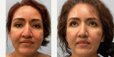35-44 year old woman treated with Rhinoplasty - This woman in her mid-forties met with Dr. Tucker to discuss her interest in nose contouring. She wanted to reshape the hump on her dorsal and she chose to proceed with a closed rhinoplasty. She looks great and is featured before and two months afterwards.