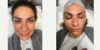 35-44 year old woman treated with Microdermabrasion - Microdermabrasion is an exfoliative technique used to remove the outer layers of the dermis. Mulitlple sessions can be used to help minimize the appearance of fine lines and wrinkles, hyperpigmentation, large pores, and acne. This is a before and after pic of one our clinics immediately following a diamond microdermabrasion session. Notice the immediate glow following treatment.