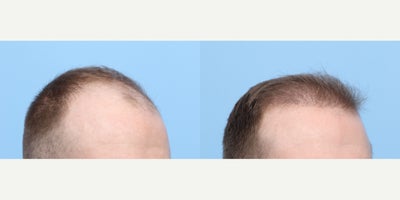 25-34 year old woman treated with FUE Hair Transplant, Hair Transplant, Hair Loss Treatment, PRP for Hair Loss, PRP Injections - This 28-year-old patient started noticing hair loss and had a lot of recession in temporal region. Dr. Wise performed an FUE hair transplant along with one session of PRP during the procedure to get these results. He will continue to see results up until 1 year mark.