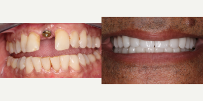 55-64 year old man treated with Dental Implants - The process of a dental implant replacement involves healing periods. Four months after the extraction and bone grafting is placed, the dental implant can be placed. After another 4 months of healing time, the results are worth the wait. Patient went with upper and lower restorations in order to control symmetry and shade match. The doctor was able to restore functionality, and feeding two birds with one seed by restoring aesthetics as well.