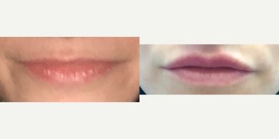 25-34 year old woman treated with Lip Augmentation - This patient was treat with only .3cc of revanesse versa in her upper lip. Versa helped create a more voluminous look with almost no swelling.