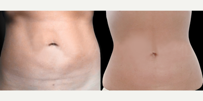 Woman treated with Lipedema Surgery - Woman treated with Lipedema Surgery