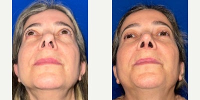 55-64 year old woman treated with Revision Rhinoplasty - Woman in her late 50s with original rhinoplasty performed many years prior outside of the country. Reconstructive revision rhinoplasty and septoplasty performed to correct deformity and help her breathe better.
