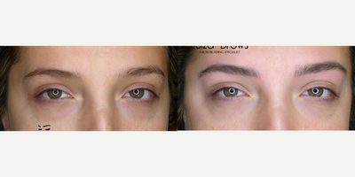 Woman treated with Microblading - Woman treated with Microblading