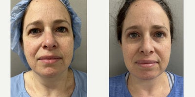 35-44 year old woman treated with Chin Liposuction - 44 y/o 3 months after an neck liposuction in our office under sedation.