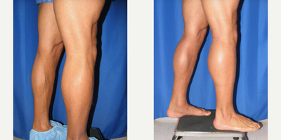 Man treated with Calf Implant - Man treated with Calf Implant