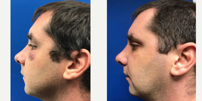 35-44 year old man treated with Laser Resurfacing - Excision in combination with Venus Viva laser treatment to eliminate this man's cyst on his face.