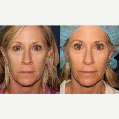 45-54 year old woman treated with Voluma - Voluma is injected into the cheeks of a woman in her 40s in order to restore lost volume.