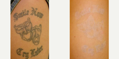 Man treated with Tattoo Removal - Male patient treated with Laser Tattoo Removal to reduce the appearance of unwanted body art on arm.