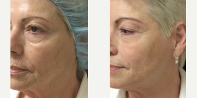 45-54 year old woman treated with CO2 Laser - CO2RE Resurfacing Before and After