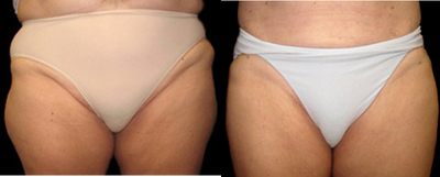 45-54 year old female treated with Aqualipo on waist and thighs - This 52-year old female was happy to have her bulges on waist and thighs removed with Aqualipo. Our doctors&nbsp;personalize each liposuction to the patient's individual needs and typically use a combination of Body Jet water liposuction and SmartLipo laser liposuction to achieve optimal fat removal and skin tightening.