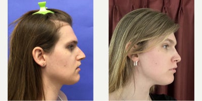 Patient treated with Adam's Apple Reduction, Forehead Reduction, Brow Lift, Facial Fat Transfer - 25 to 34 year-old female patient is 1 year post-op from Facial Feminization surgery. Her procedures included:Forehead Lift, Hairline Lowering, Superorbital Bone Reduction and ContouringSeptorhinoplasty (closed) with Cartilage Grafts and WeirsChin Reduction and ContourThyroid Cartilage ShaveVoice FeminizationFat Augmentation to Lips
