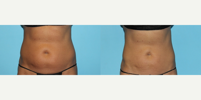45-54 year old woman treated with Vanquish - Vanquish fat reduction