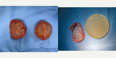 35-44 year old woman treated with  Enbloc Capsulectomy for Capsular Contracture Treatment, Breast Implant Removal - Female patient with Breast Implant Illnes (BII) and Asia Syndrome after breast augmentation surgery. She underwent for a total Capsulectomy surgery withenbloc surgery technique. You can see the total capsule removal with her implants inside the capsule, and the capsule thickness.