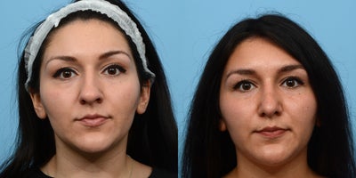 25-34 year old woman treated with Septoplasty - This patient came to us to fix her breathing issues, and make her nose smaller and more symmetrical. She chose Dr. Wise because of his ability to change someone's appearance while still helping them look like themselves, and she couldn't be more thrilled with her natural-looking results.