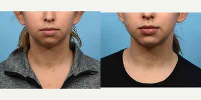 18-24 year old woman treated with Chin Surgery - chin augmentation